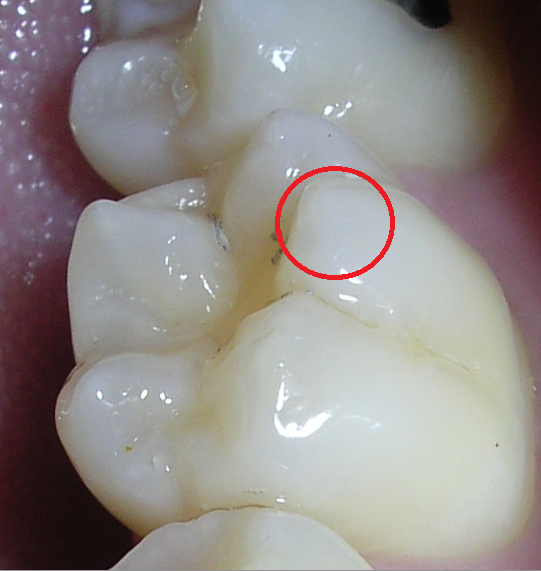 Cuspides de Apoyo y Balance by