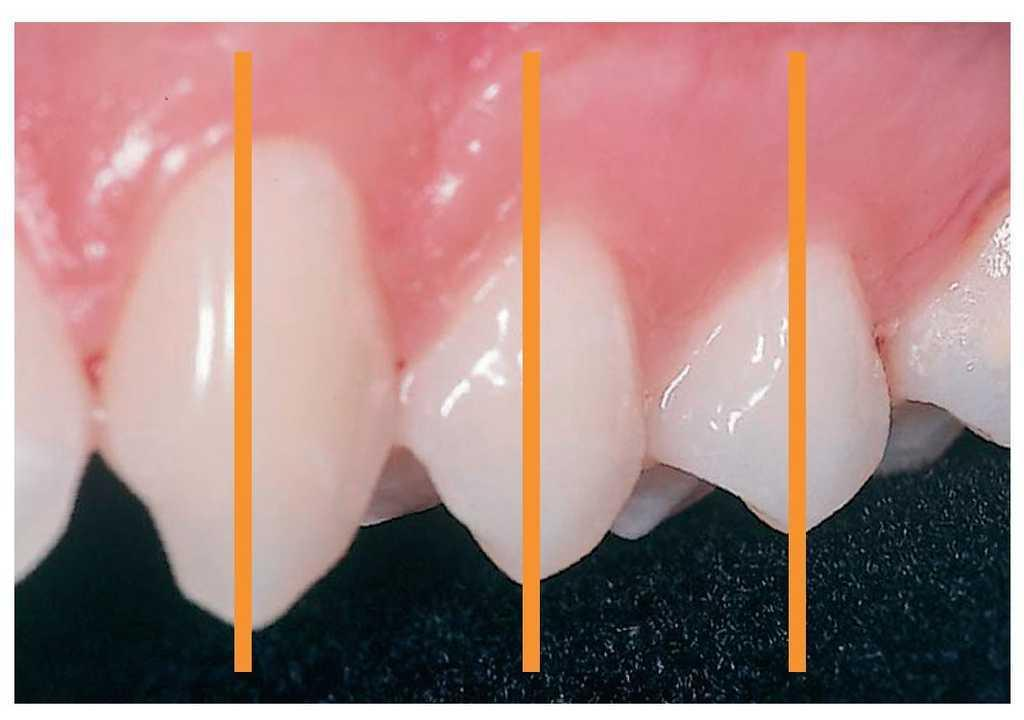 Cuspides de Apoyo y Balance by