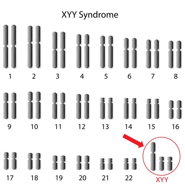 Jacob's Syndrome Infographic by Hao Ming Hu - Infogram