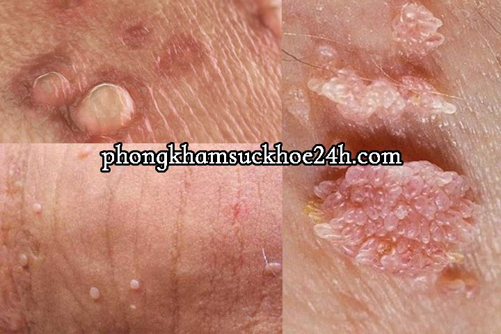 Đầu chim bị sưng, ngứa