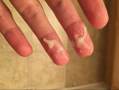 Ngứa Vùng Kín Ra Huyết Trắng